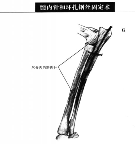 小动物骨科手术器械:近端尺骨骨折和桡骨头脱_小动物外科器械_小动物